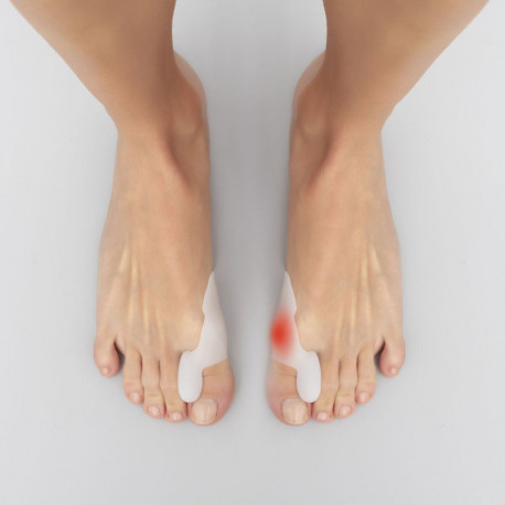 Silikoonist bunion defekti korrektor kaitse Bunilief InnovaGoods 2 Ühikut